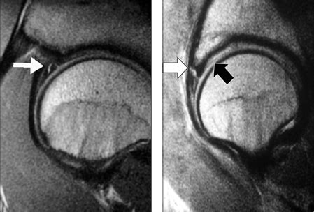 acetabular labral tear special tests|best imaging for labral tear.